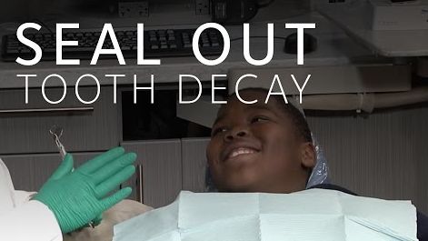 a child in the dental exam chair smiling with text - seal out tooth decay