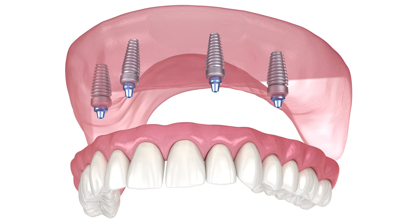 Full Arch with Only Four Implants graphic