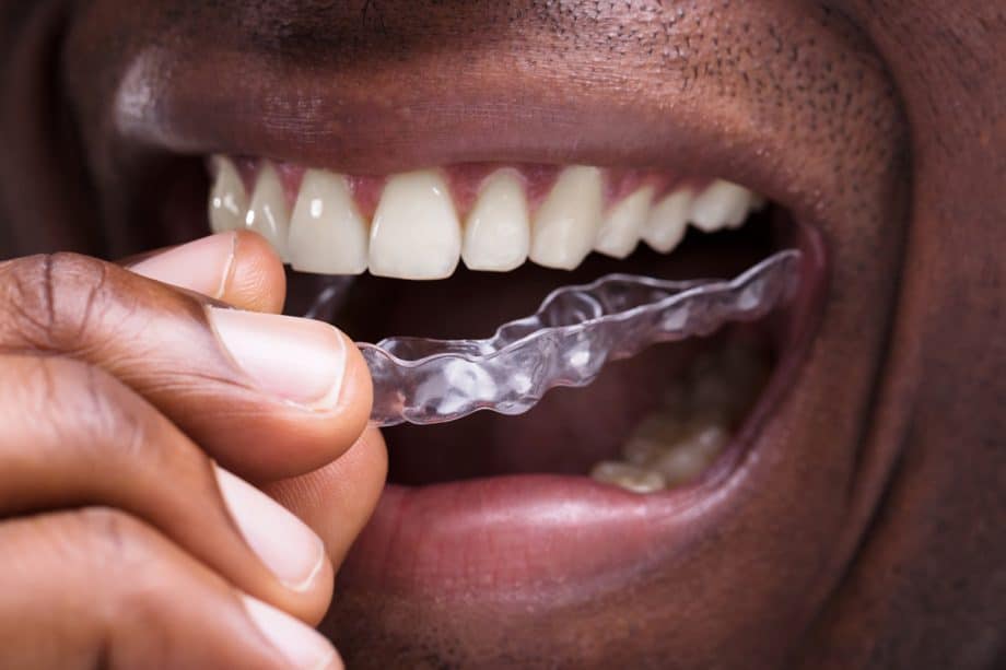 How Do You Clean Your Invisalign Retainers & Tray?