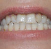 before picture of woman's mouth showing teeth