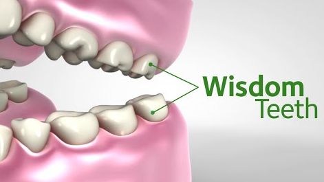 graphic indicating where wisdom teeth are